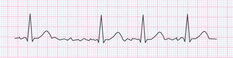 migotanie przedsionkow ekg